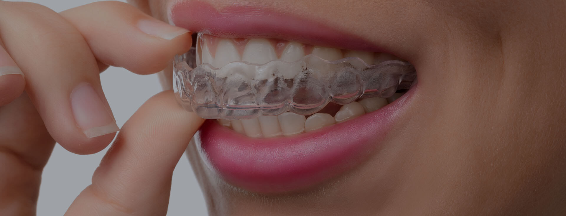 close up of a person putting on their Invisalign clear aligners