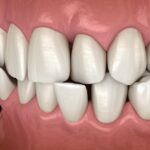 image of crossbite with post on signs your child may need orthodontics, orthodontics for kids, bite issues, crowded teeth, baby teeth loss, Rock Hill Orthodontics, Cherry Hill NJ, braces for kids, early orthodontic care