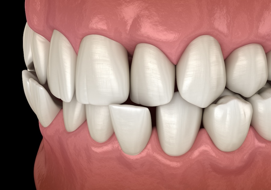 image of crossbite with post on signs your child may need orthodontics, orthodontics for kids, bite issues, crowded teeth, baby teeth loss, Rock Hill Orthodontics, Cherry Hill NJ, braces for kids, early orthodontic care