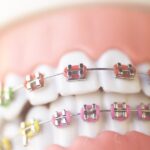 braces colors on metal braces