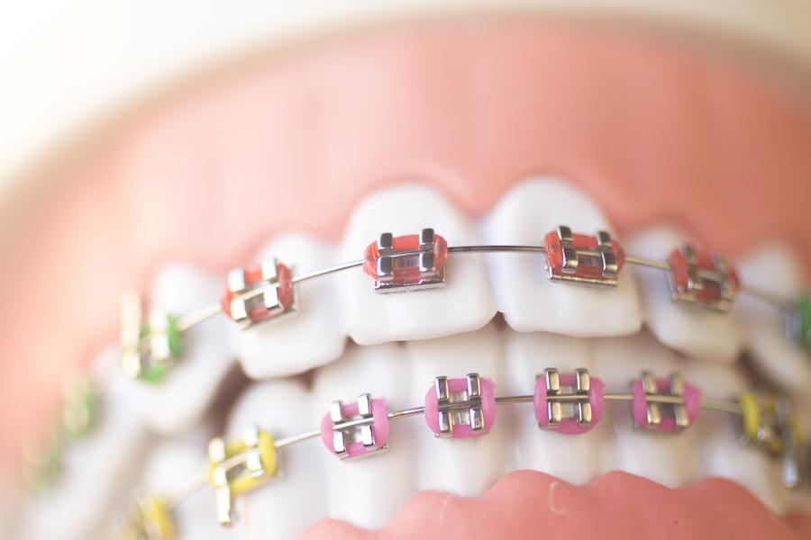 braces colors on metal braces