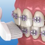 how to clean braces, toothbush on braces