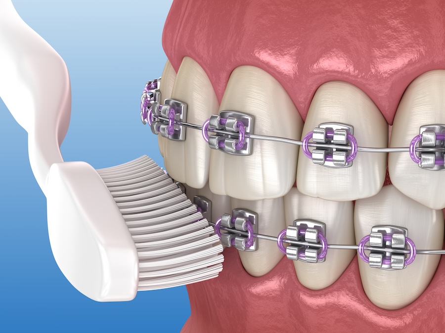 how to clean braces, toothbush on braces