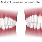 overbite vs normal occlusion