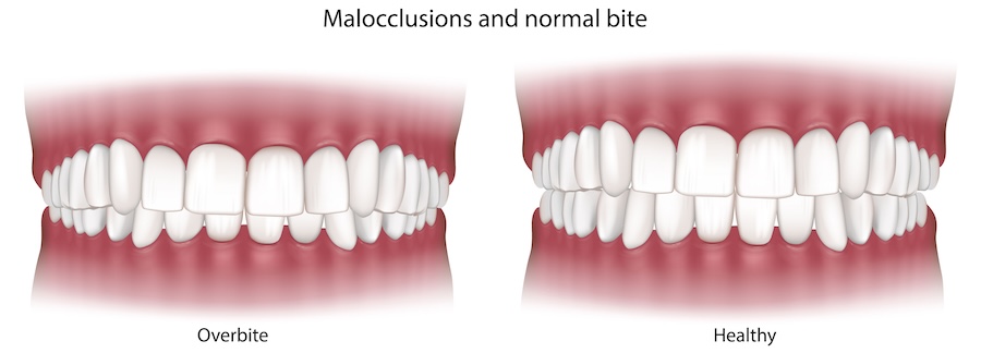 overbite vs normal occlusion
